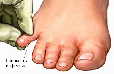 грибковая инфекция на ногах